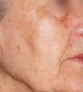 Efter IPL behandling Frax 1550