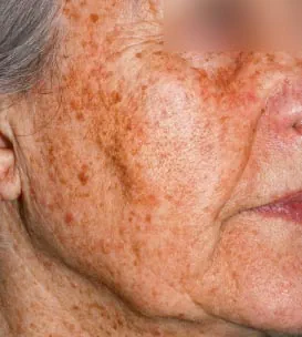 före IPL behandling Frax 1550