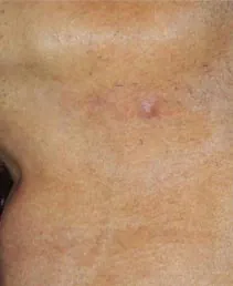 Vikor Klinik Frax 1550