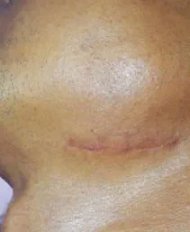 Vikor Klinik Frax 1550