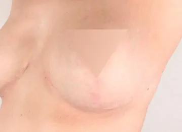 Vikor Klinik Frax 1550