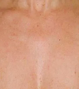 Efter IPL behandling Frax 1550