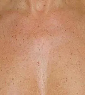 före IPL behandling Frax 1550