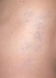 Efter IPL behandling Frax 1550