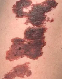 före IPL behandling Frax 1550