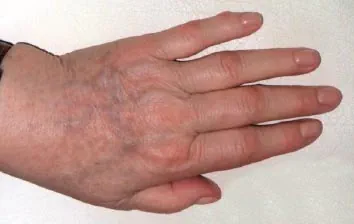 Efter IPL behandling Frax 1550