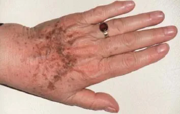 före IPL behandling Frax 1550