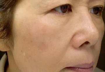 Efter IPL behandling Frax 1550