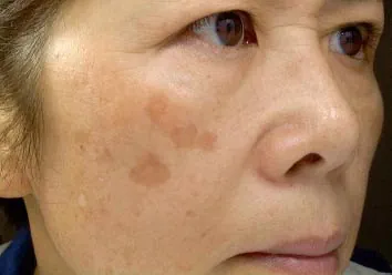 före IPL behandling Frax 1550