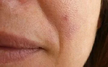 Efter IPL behandling Frax 1550