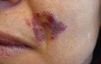 före IPL behandling Frax 1550