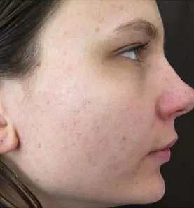 Efter IPL behandling Frax 1550