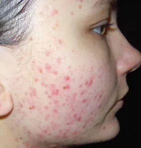 före IPL behandling Frax 1550