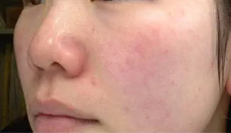 Efter IPL behandling Frax 1550