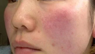 före IPL behandling Frax 1550