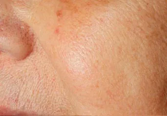 Efter IPL behandling Frax 1550