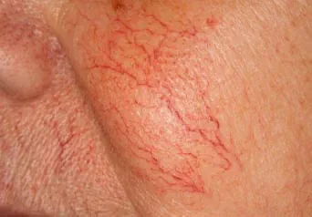 före IPL behandling Frax 1550