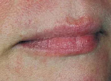 Efter IPL behandling Frax 1550