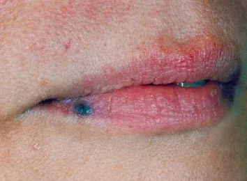 före IPL behandling Frax 1550