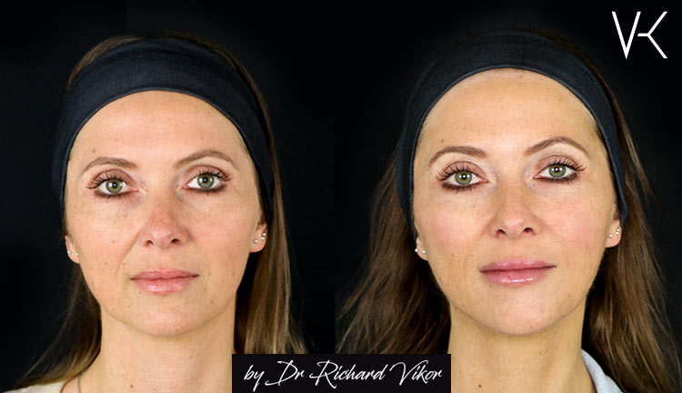 Full Face fillers  Vikor Klinik Göteborg och Jönköping