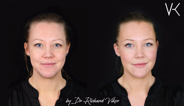Full Face fillers  Vikor Klinik Göteborg och Jönköping