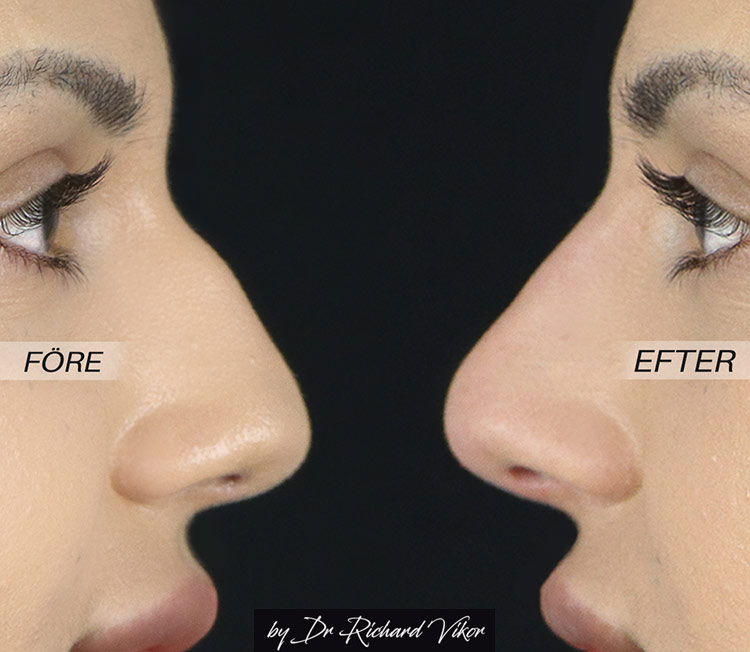 Full Face fillers näsa Vikor Klinik Göteborg och Jönköping