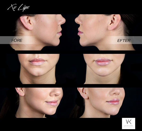 XO Lips läppar filler Vikor