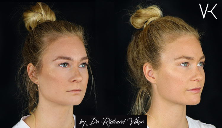 XO Lips fillers läppar Vikor Klinik Göteborg och Jönköping