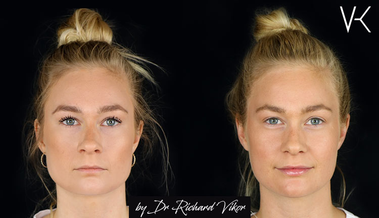 XO Lips fillers läppar Vikor Klinik Göteborg och Jönköping