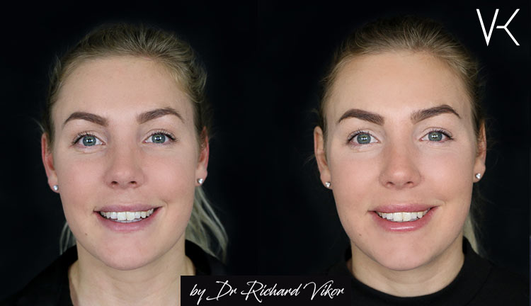 XO Lips fillers läppar Vikor Klinik Göteborg och Jönköping