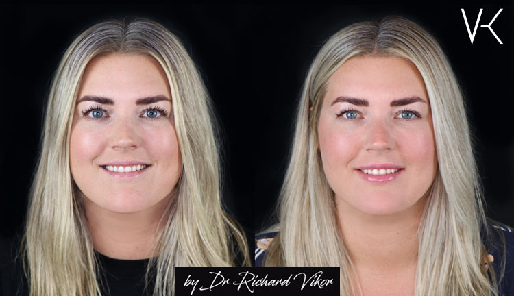 XO Lips fillers läppar Vikor Klinik Göteborg och Jönköping