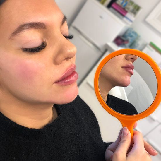 XO Lips läppar injektion Vikor
