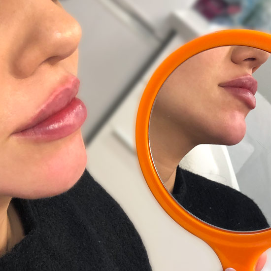 XO Lips läppar injektion Vikor
