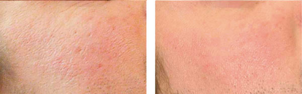 Vikor Klinik före efter biorevitalisering PRX_T33