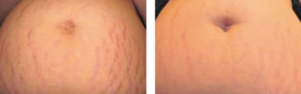 Vikor Klinik före efter biorevitalisering PRX_T33