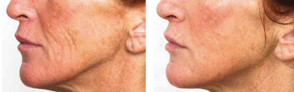 Vikor Klinik före efter biorevitalisering PRX_T33