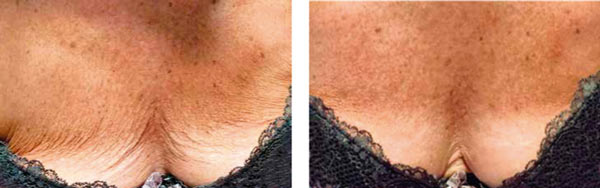 Vikor Klinik före efter biorevitalisering PRX_T33