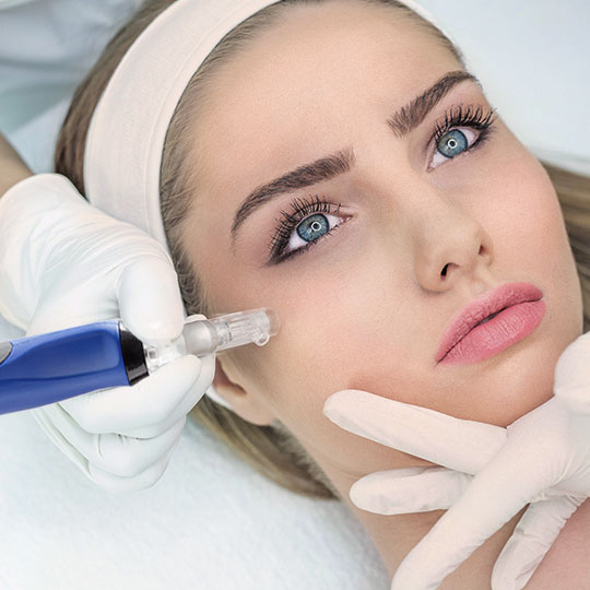 Microneedling Skin Pen Göteborg Malin, Hudterapeut Vikor Klinik